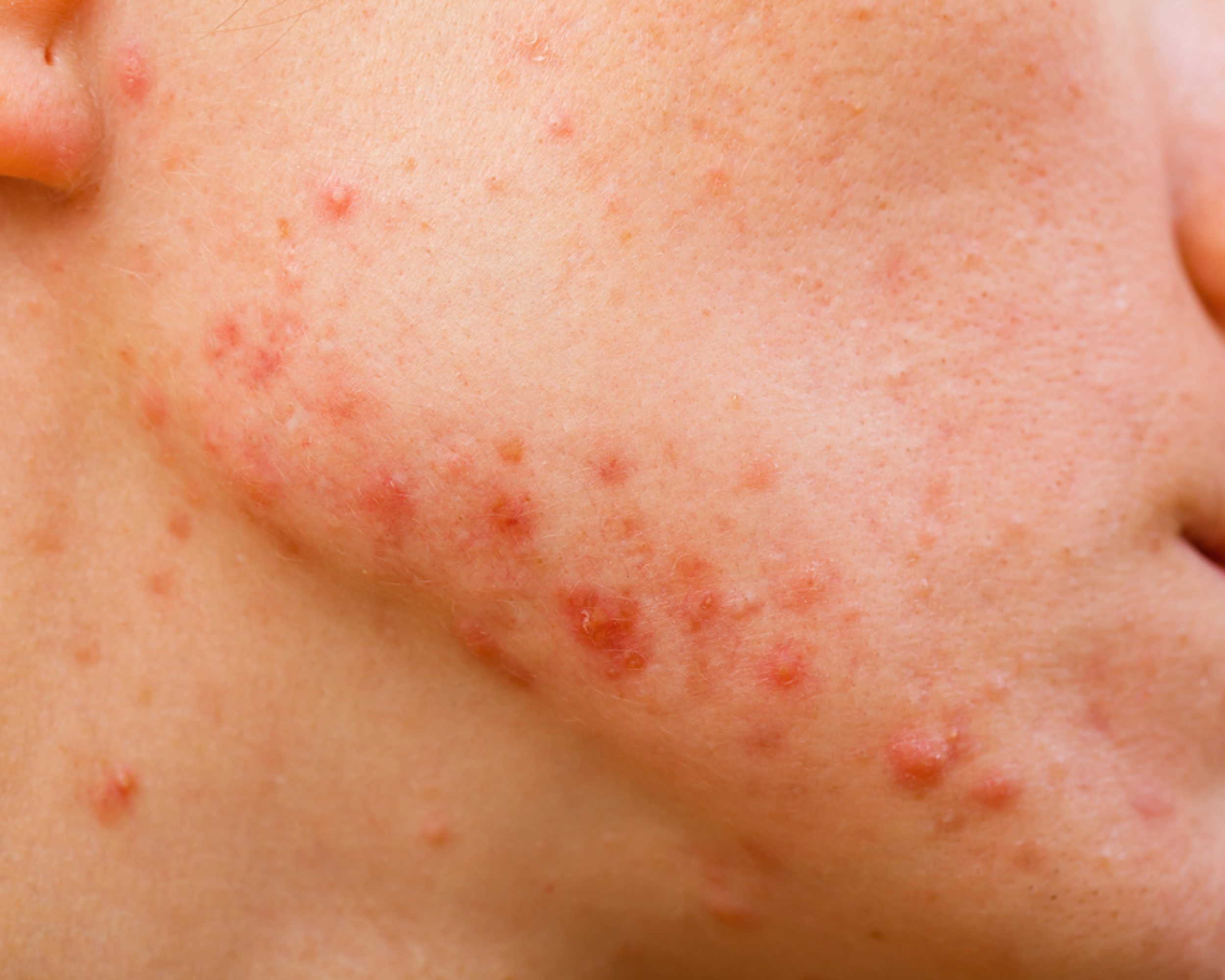 Cystic Acne photo