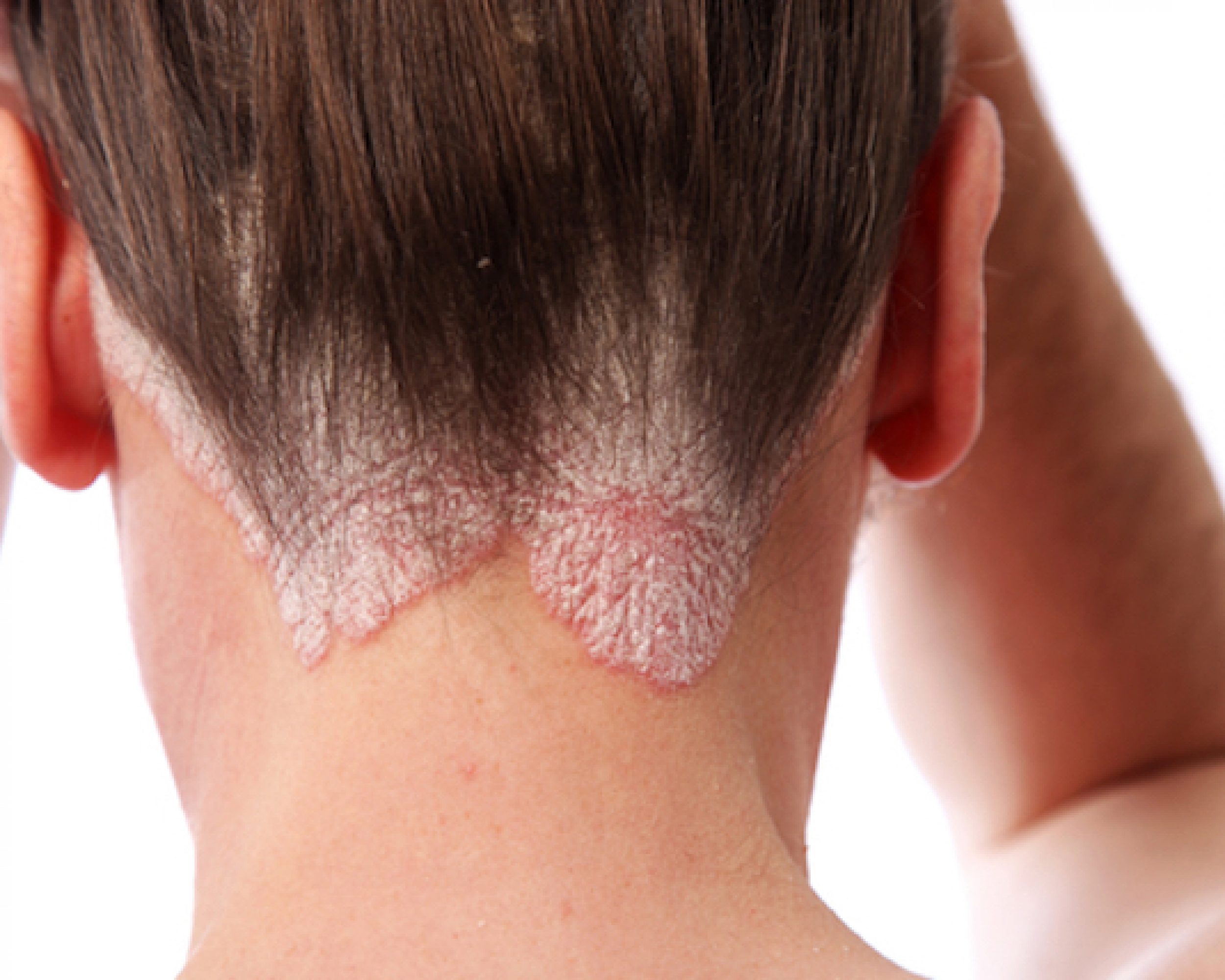 Scalp Psoriasis